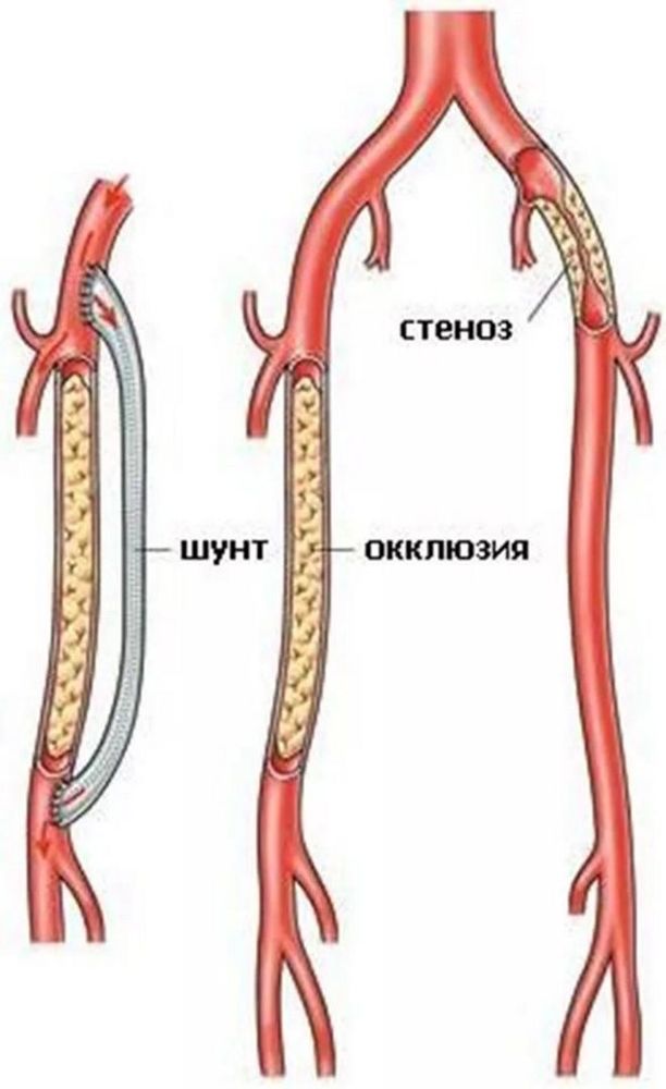 К чему приводит закупорка сосудов в ноге. Признаки и методы лечения закупорки сосудов на ногах