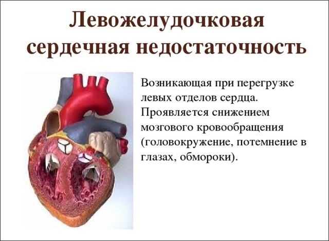 Синдром острой левожелудочковой недостаточности: первая помощь и лечение