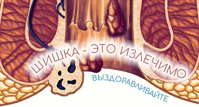 Мазь от геморроя Нифедипин