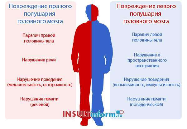 Инсульт левая или правая сторона, последствия, сколько живут