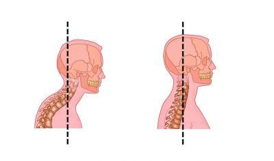 Как убрать горб на спине: эффективные способы лечения