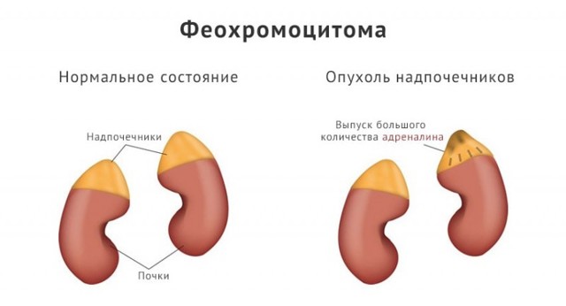 Ночная полиурия у женщин лечение - Все про почки