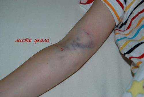 Капельница воздух в вену