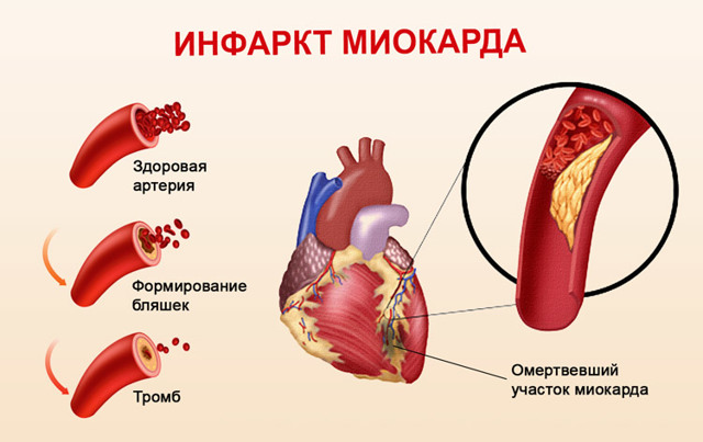 Сколько инфарктов может перенести человек - Боль в Сердце
