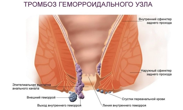 Тромбоз наружного геморроидального узла: причины и лечение