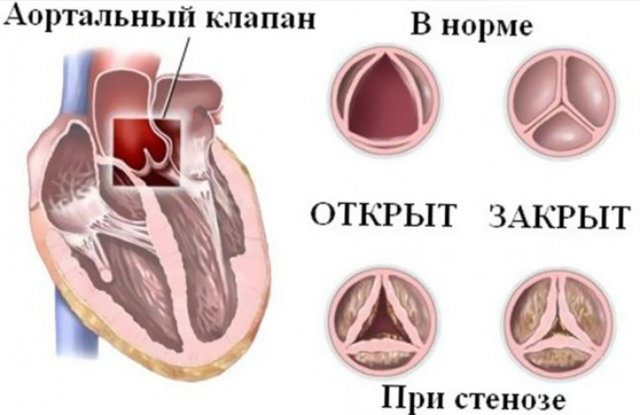 Боли в области сердца при различных заболеваниях - причины, характер, лечение