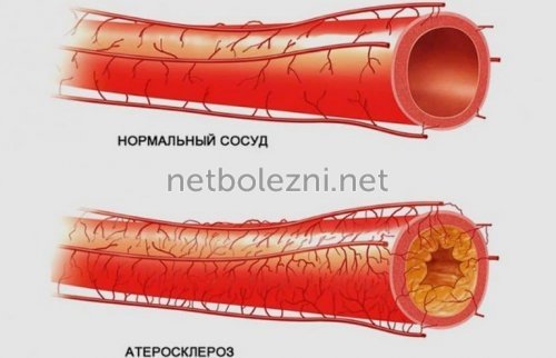 Осложнения после стентирования сосудов сердца и коронарных артерий - компания Стентоник
