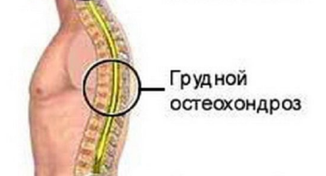 Экстрасистолия при остеохондрозе - что это такое и как лечить