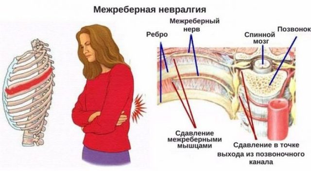 Боль в грудной клетке: как отличить сердечную боль от других болей