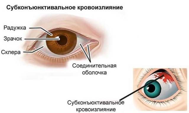 Кровоизлияние в глаз: лечение и причины