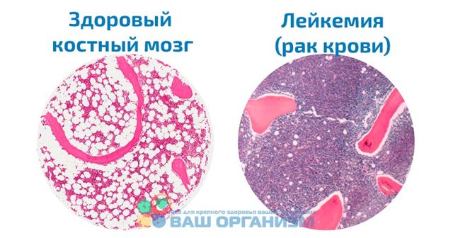 Лейкоз - злокачественное заболевание крови