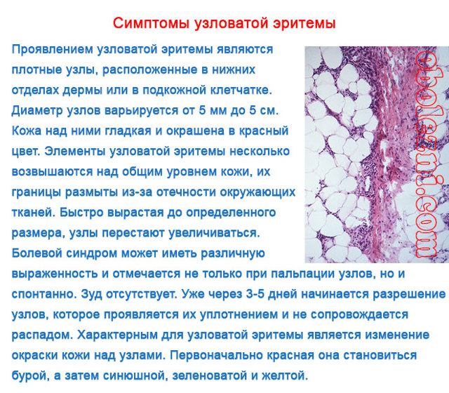 Узловатая эритема: фото, симптомы и лечение