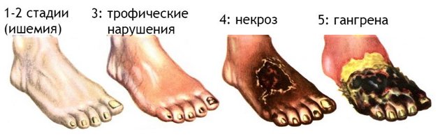 Рожа на ноге фото начальная стадия: Как начинается? - BadAcne