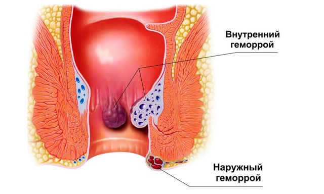 Геморрой - причины, симптомы, диагностика и лечение
