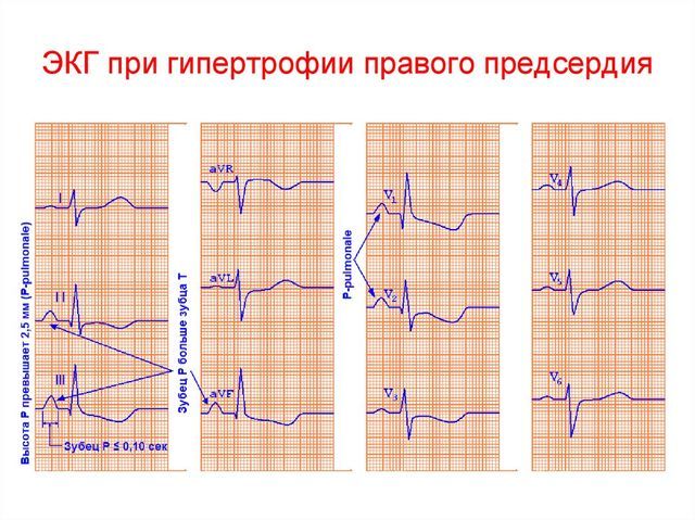 Гипертрофия правого предсердия на ЭКГ: симптомы перегрузки сердца