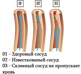 Диагностика атеросклероза