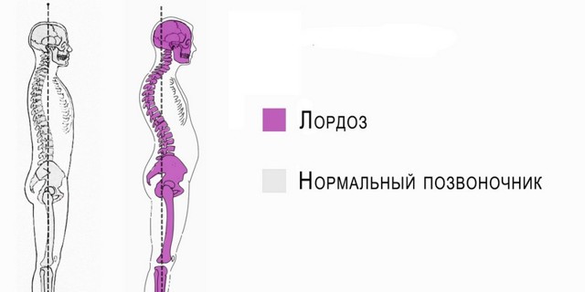 Лордоз – что это такое, как лечить и предупредить