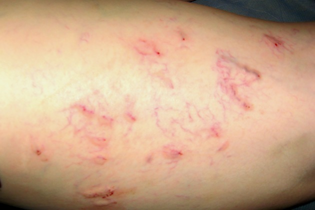 Осложнения и последствия после склеротерапии