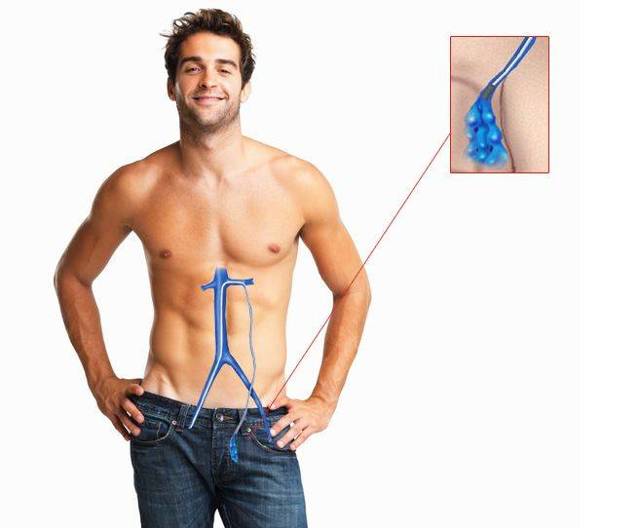 Варикоз на яичках: основные проявления