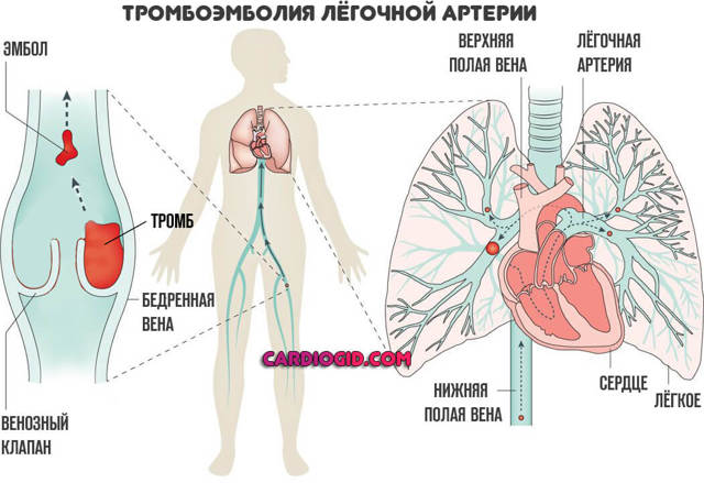 Тромбоэмболия легочной артерии: симптомы и лечение