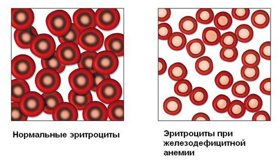 Железодефицитная анемия, симптомы и лечение