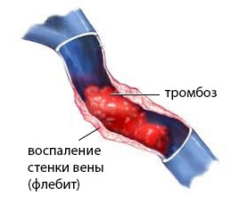 Что такое Яремная вена?