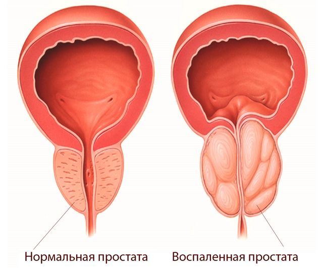 Трихомониаз - симптомы у мужчин и женщин, профилактика, лечение
