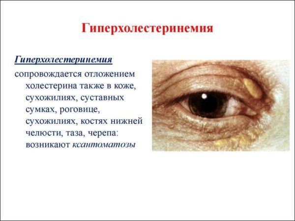 Гиперхолестеринемия: что это такое – диета при семейном типе