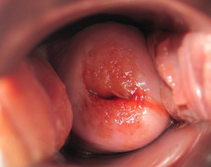 Кровянистые выделения на ранних сроках беременности