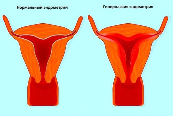 Как остановить маточное кровотечение в домашних условиях, препараты
