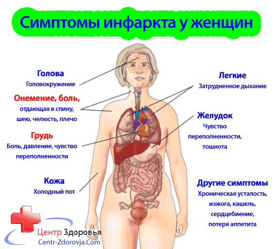 Инфаркт - симптомы и первые признаки инфаркта миокарда у женщин