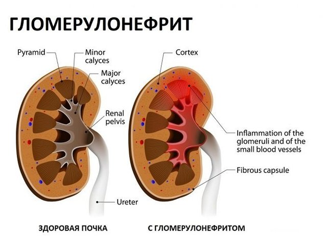 Кровь в моче: причины у женщин
