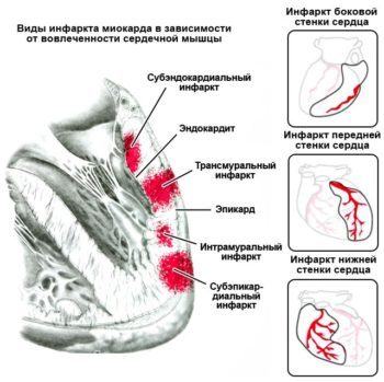 Крупноочаговый инфаркт миокарда