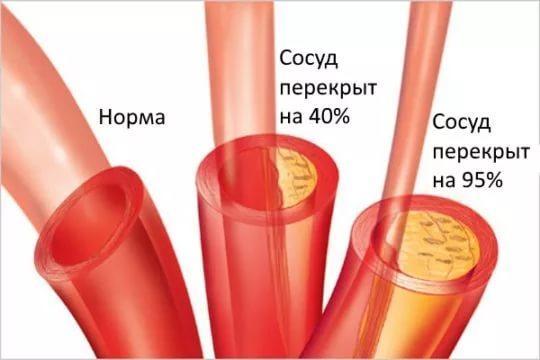 Максимально высокое артериальное давление у человека - Все про гипертонию