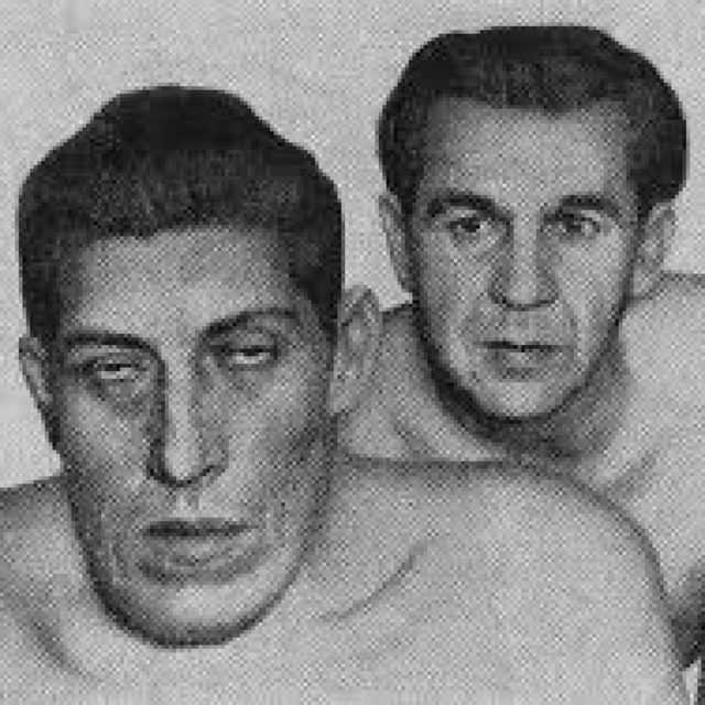 Акромегалия - причины, симптомы, лечение