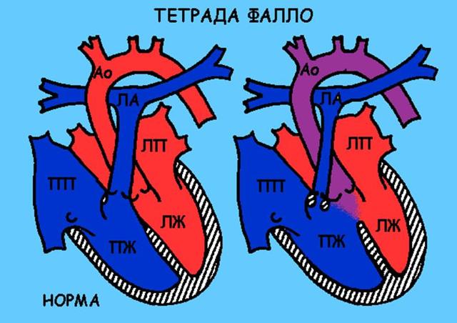 Операция при пороке сердца у ребенка как проходит -