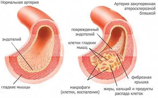 Нестенозирующий атеросклероз артерий
