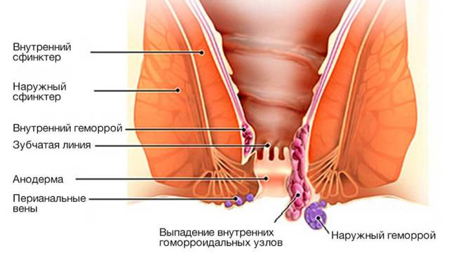 Глицериновые свечи после родов со швами. Применение глицериновых свеч после родов