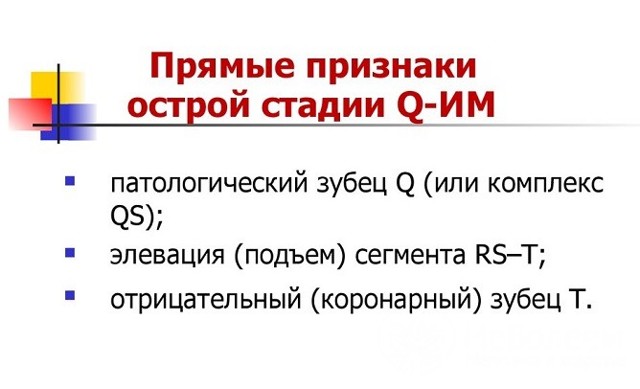 ЭКГ при инфаркте миокарда: фото пленок и расшифровка признаков