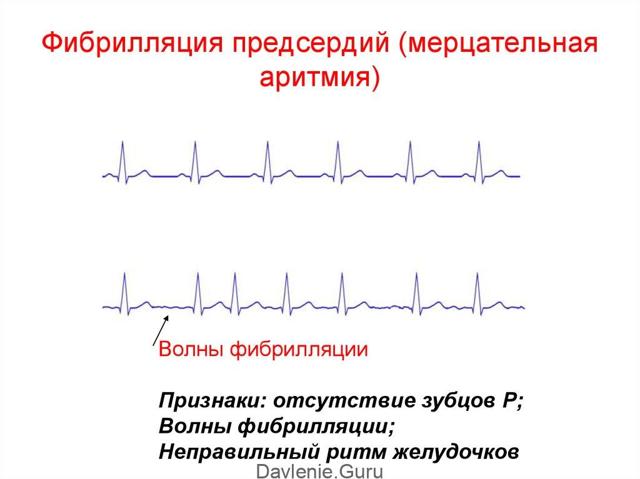 Тахикардия после алкоголя или с похмелья: что делать