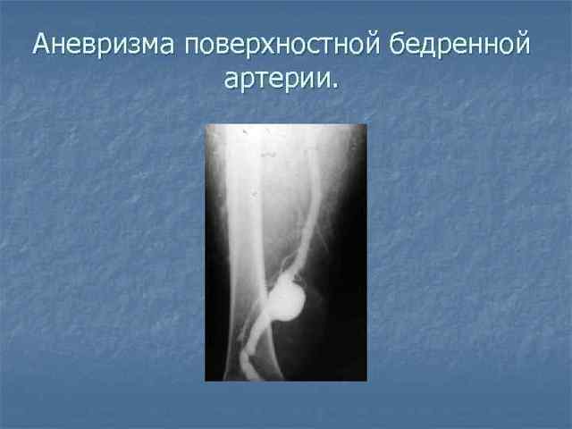 Аневризма бедренной артерии симптомы