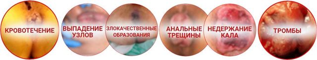 Геморрой - причины, симптомы, диагностика и лечение