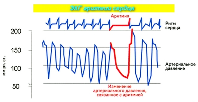 Скорая помощь при аритмии