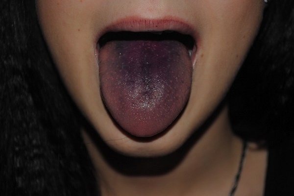 Черный налет на языке — начало больших проблем