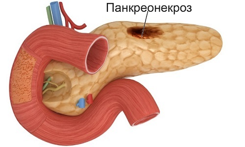 Что такое геморрагический панкреонекроз