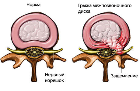 Болит посередине грудной клетки: причины, лечение, диагностика.