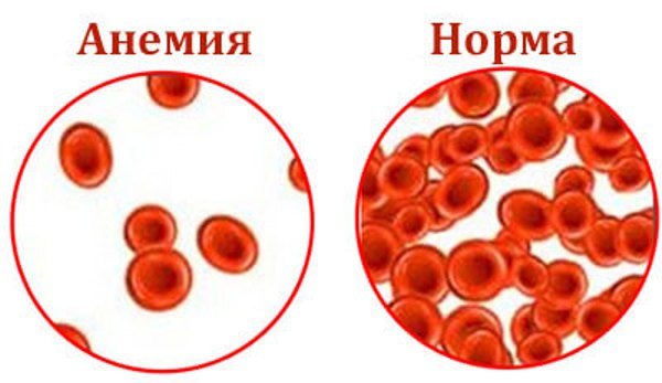 Гемолитическая анемия – виды, симптомы и лечение