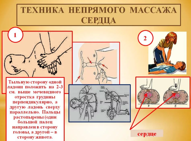 Что такое Непрямой массаж сердца?