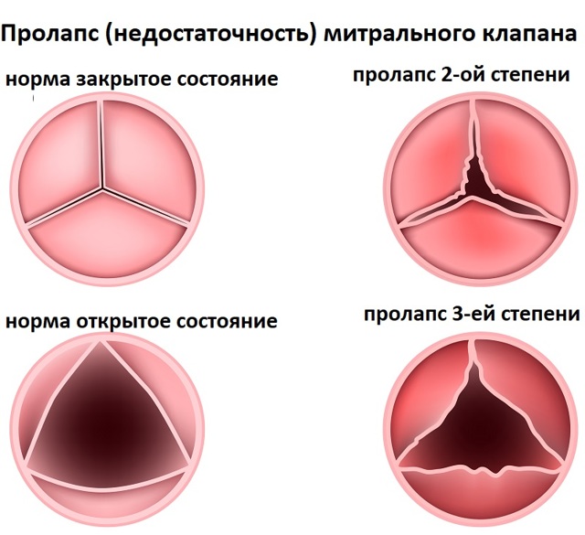Регургитация митрального клапана 1 и 2 степени