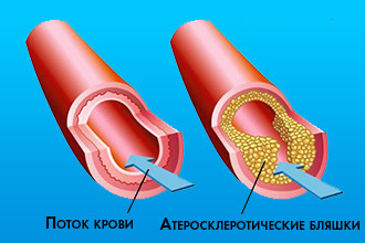 Коронарная смерть: причины, первая помощь, прогноз